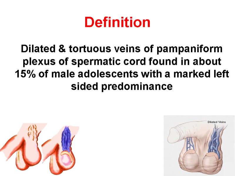 Definition    Dilated & tortuous veins of pampaniform plexus of spermatic cord